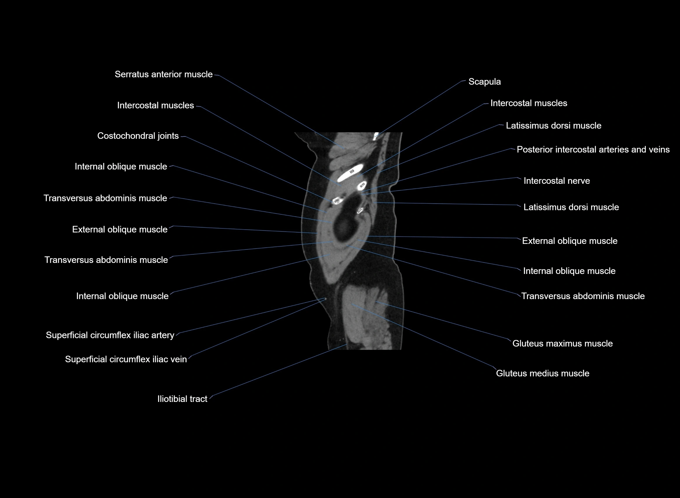 CT Abdomen sagittal cross sectional anatomy labelled radiology image -00104.webp